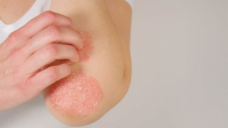 Soluciones Efectivas: Lociones y Ung&uuml;entos para Aliviar la Psoriasis