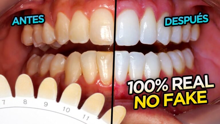 Blanqueamiento Dental: Cuidado con Productos de Farmacia