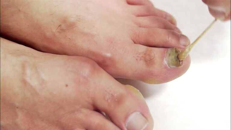 Cuidado Efectivo de Hongos con Productos Farmacéuticos