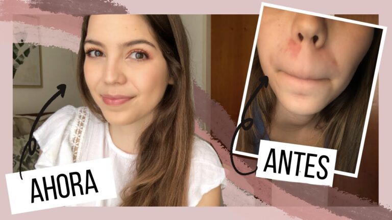 Cremas Especializadas para el Cuidado del Eczema: Soluciones Efectivas