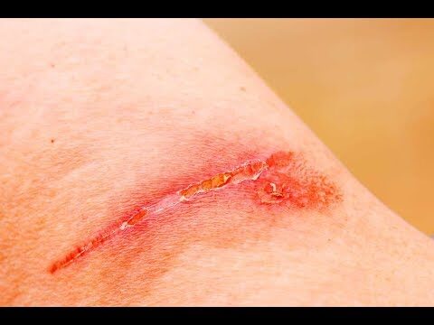 Productos de Calidad para el Cuidado de Heridas en Farmacias