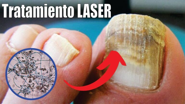 Cuidado Integral para Hongos: Soluciones de Farmacia Efectivas